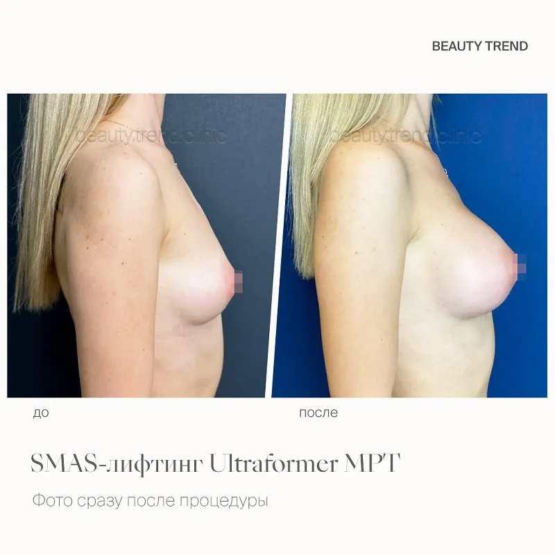 Увеличение груди имплантами, 4А - 1